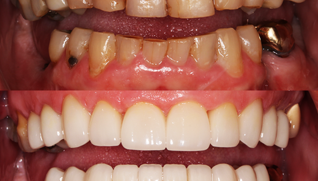 Mosinee full-mouth rehabilitation