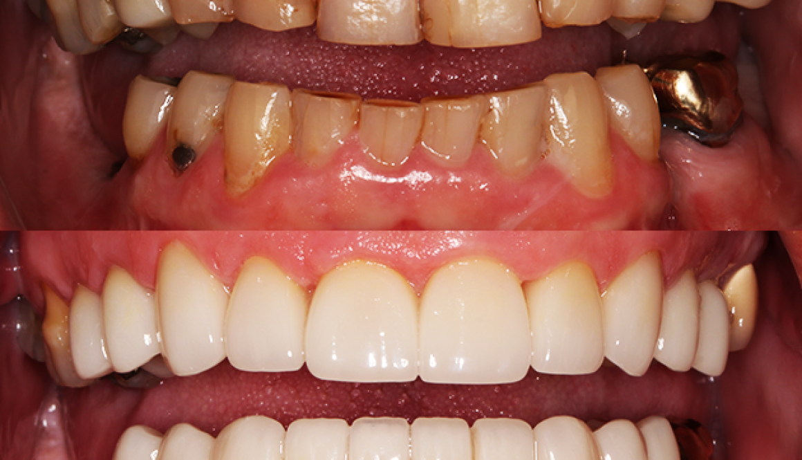 Mosinee full-mouth rehabilitation