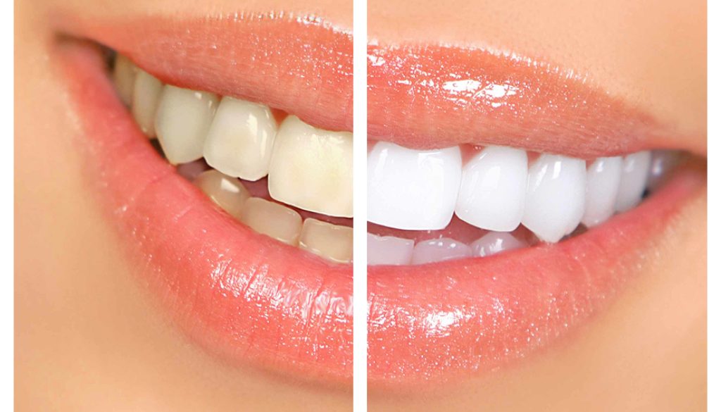 Mosinee dentist teeth whitening