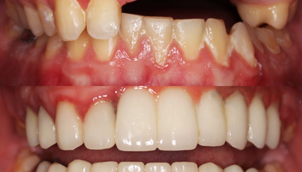 severe dental trauma Mosinee
