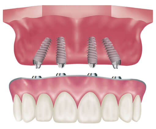 All-On-4® Dental Implants