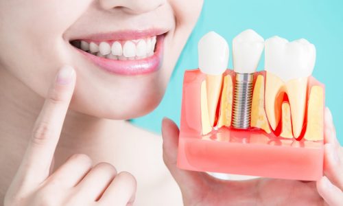 Tooth Implant