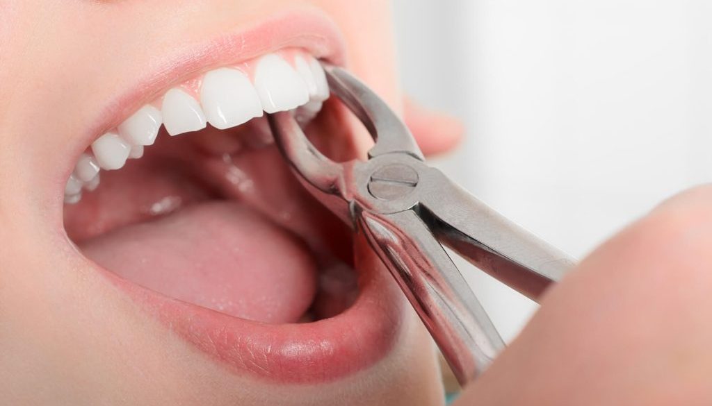Wisdom Teeth Removal Mosinee