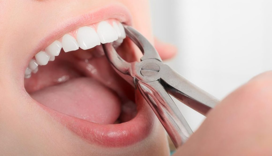 Wisdom Teeth Removal Mosinee