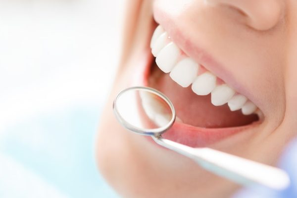 Dental Sealants