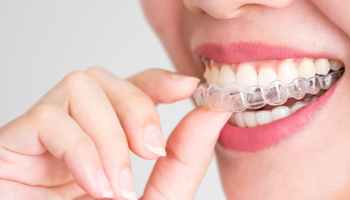 Clear Braces Mosinee dentist