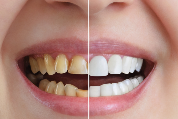 Fluoride Treatment 