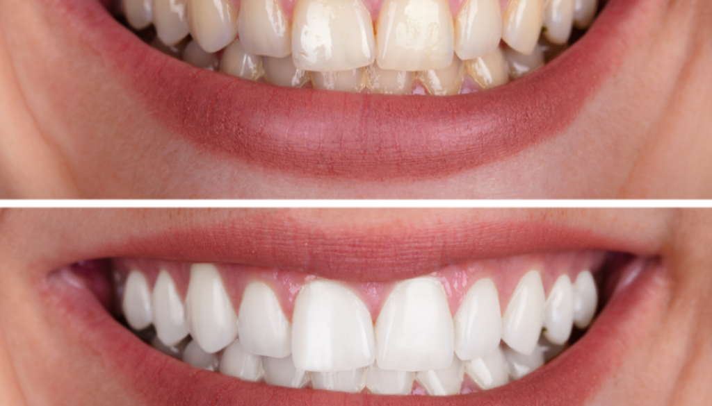 Teeth whitening Mosinee dentist