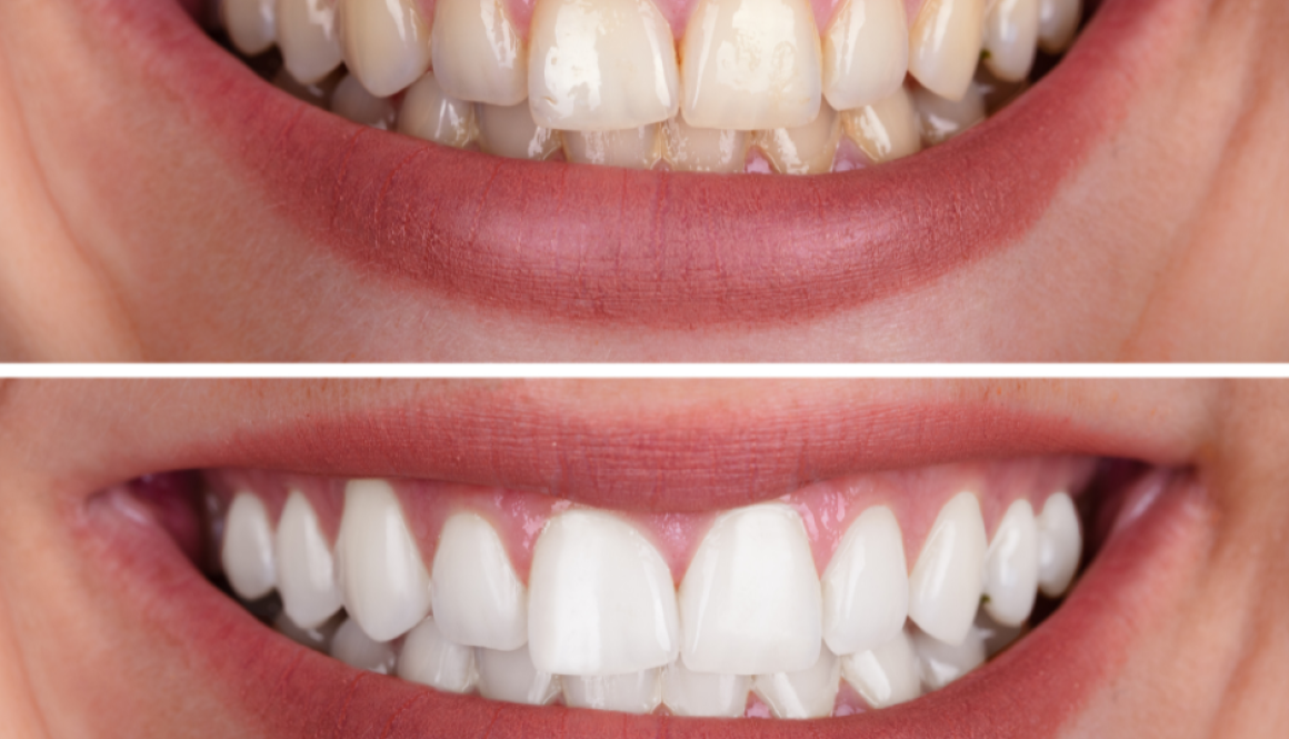Teeth whitening Mosinee dentist