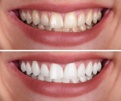 Teeth whitening Mosinee dentist