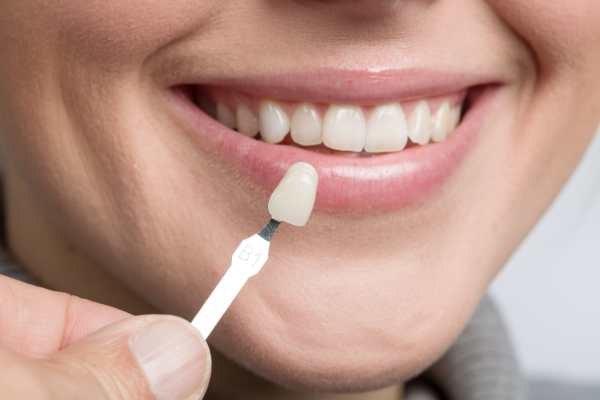 Teeth Whitening 