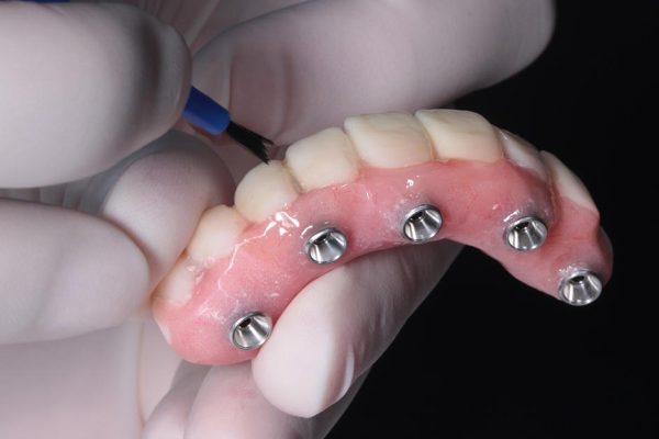 Dental Implants