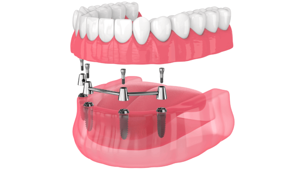 Dental Implants Mosinee Dentist