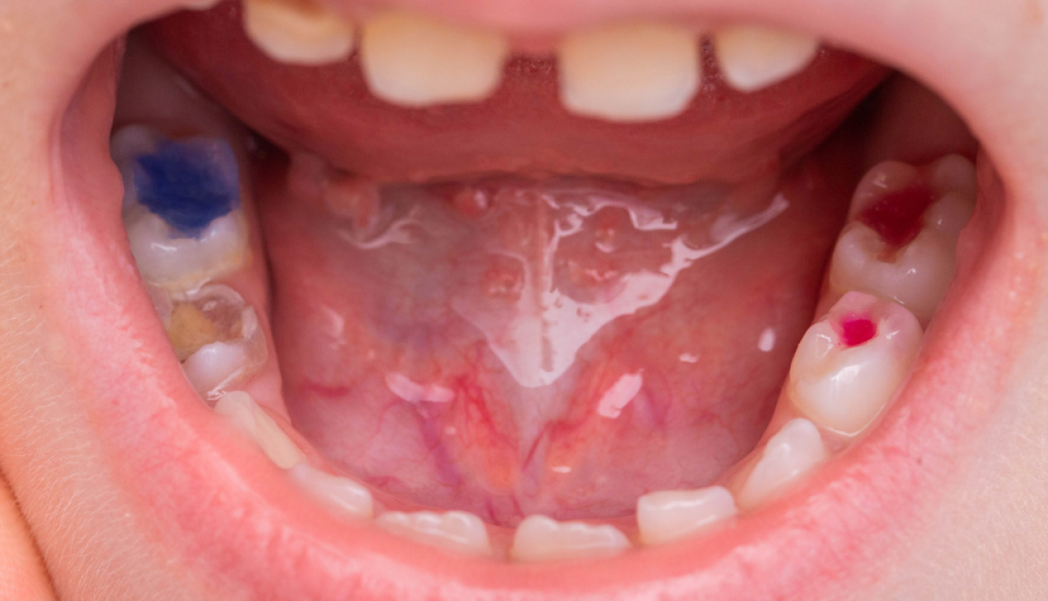 Tooth decay prevention in Mosinee